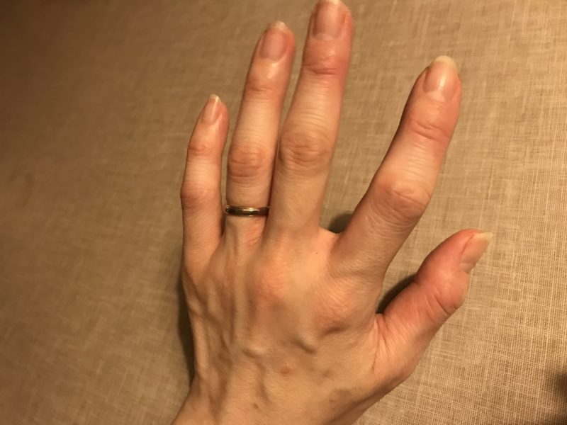 指の関節が膨らむ　自己免疫疾患maladies auto-immunes