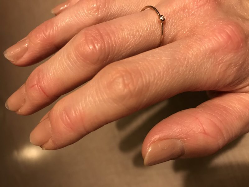 指の第一関節の膨らみ　リウマチ科